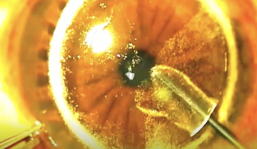 Presbyopic Allogenic Refractive Lenticule (PEARL)