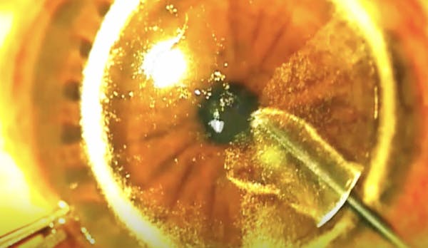 Presbyopic Allogenic Refractive Lenticule (PEARL) thumbnail