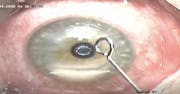 Excimer Laser Shaped Allograft Corneal Inlays for Presbyopia