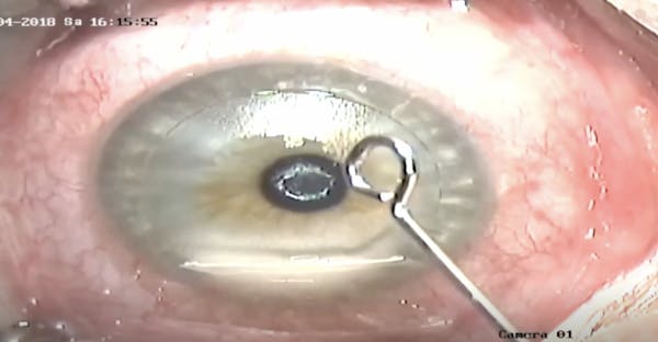 Excimer Laser Shaped Allograft Corneal Inlays for Presbyopia thumbnail
