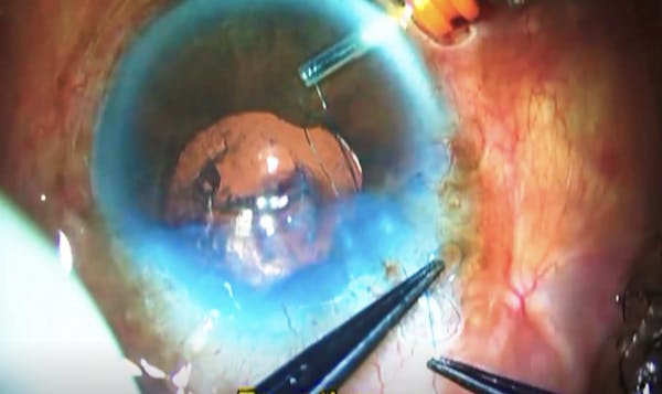 Pinhole Pupilloplasty for Highly Aberrated Corneas thumbnail