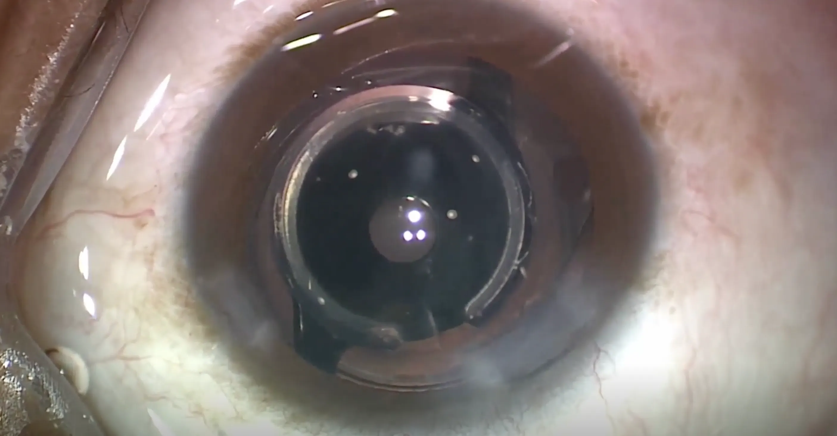 Small Aperture IOL - Eyetube