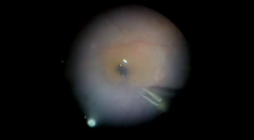 Inverted ILM Flap for Traumatic Macular Hole With PVR Retinal Detachment