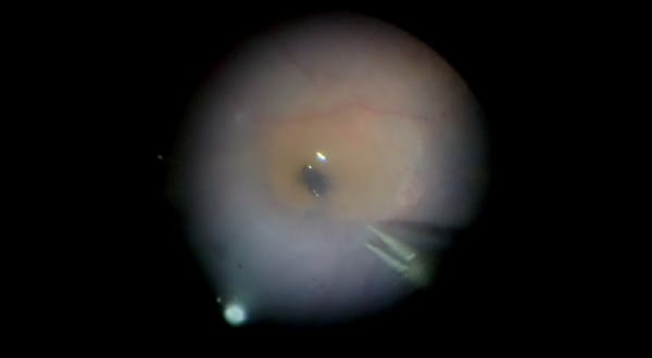 Inverted ILM Flap for Traumatic Macular Hole With PVR Retinal Detachment thumbnail