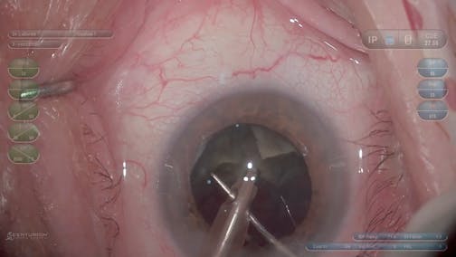 Cataract Pieces: Tip-Toe Zonular Dehiscence