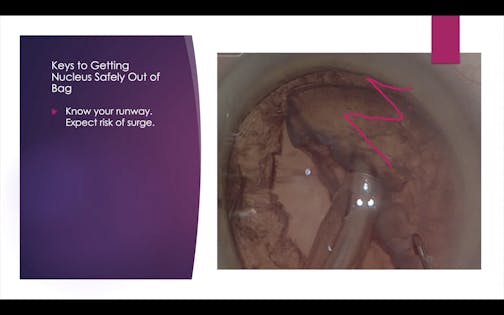 Nucleus Removal From Capsular Bag