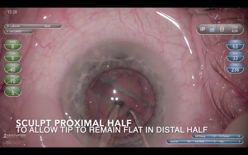 Cataract Pieces: Sculpting a Groove