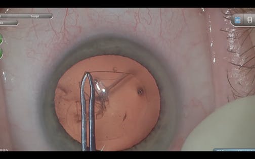 Manual Capsulotomy During Cataract Surgery