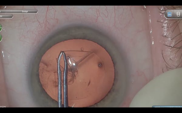 Manual Capsulotomy During Cataract Surgery thumbnail