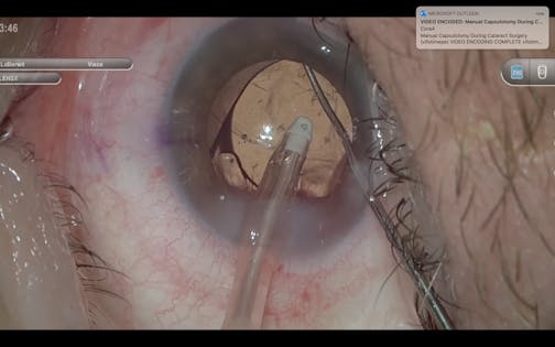 Reverse Optic Capture of a Toric IOL in Femtosecond Laser Cataract Surgery