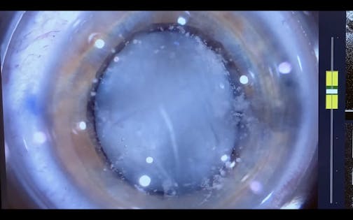 Advantage of Femtosecond Laser Capsulotomy in White Swollen Lens