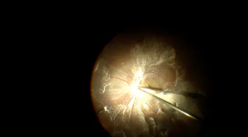 Subfoveal Fibrosis Removal in Young Patient With Myopia