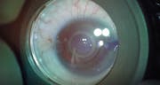 Intumescent Cataract Surgery With CapsuLaser