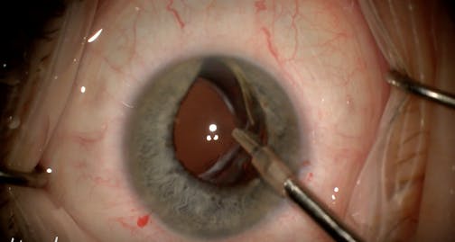 IOL Reposition With Punch and Rescue Technique