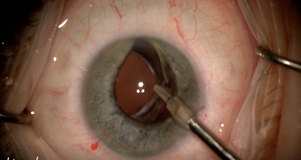 IOL Reposition With Punch Technique thumbnail