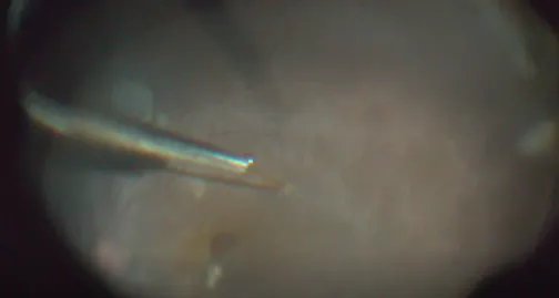 Subretinal Perfluorocarbon Liquid Bubble Removal