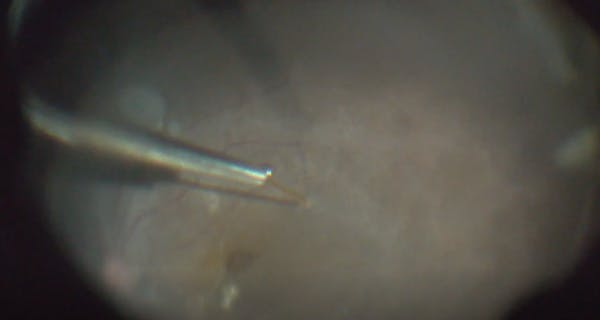 Subretinal Perfluorocarbon Liquid Bubble Removal thumbnail