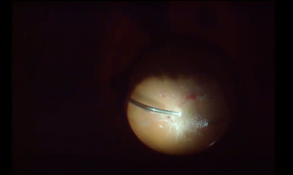 Tabletop Retinal Detachment thumbnail