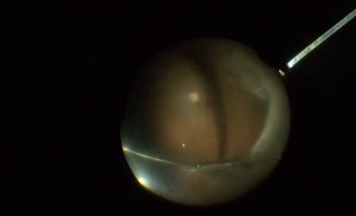 Retinal Detachment With Zipper Syndrome