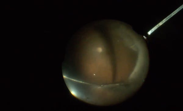 Retinal Detachment With Zipper Syndrome thumbnail