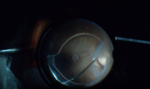 Management of Localized Retinal Detachment Without PFO