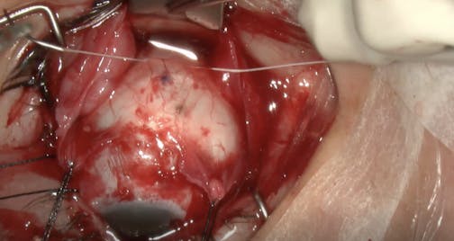 Ab Externo Surgery in Myopic Retinal Detachment