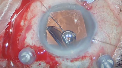 IOL Rescue With Intrascleral Flanged Haptics