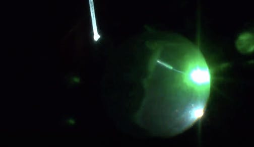 Double Procedure During Longstanding Retinal Detachment Repair