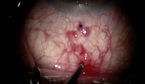 Xen Gel Stent Implantation With Ologen