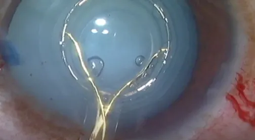 Zepto Cataract Surgery and Premium IOL Implantation