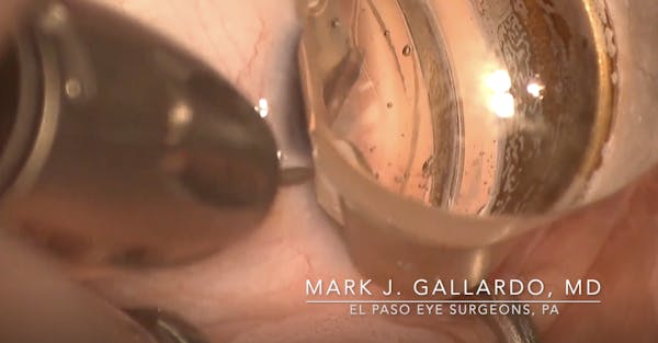Combined Ab Interno Canaloplasty With Hydrus Implantation thumbnail