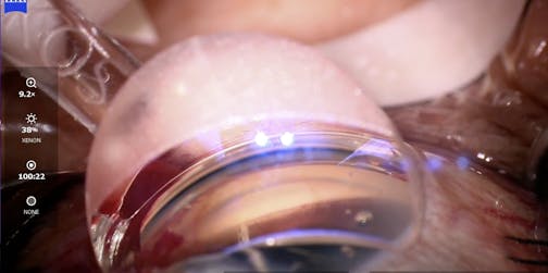 iStent inject W: Flushing of the Distal Venous System