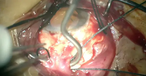 Chandelier-Assisted Scleral Buckling