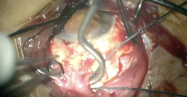 Chandelier-Assisted Scleral Buckling thumbnail