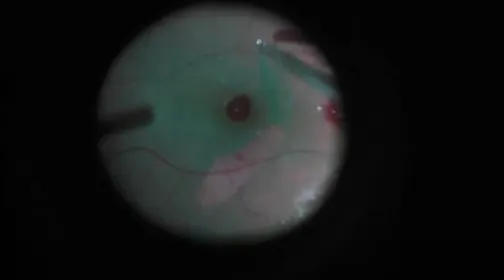 Internal Limiting Membrane Macularrhexis