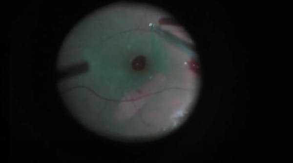 Internal Limiting Membrane Macularrhexis thumbnail