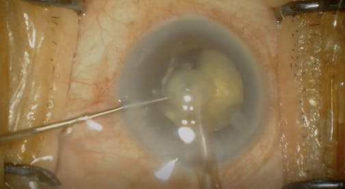 Hypermature Cataract With Phacolytic Glaucoma