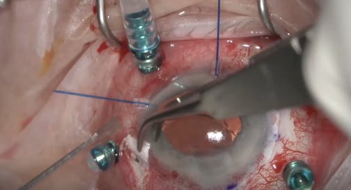 Blunt Trauma With Iridodialysis and Zonular Weakness