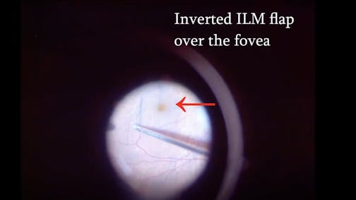 Myopic Lamellar Macular Hole