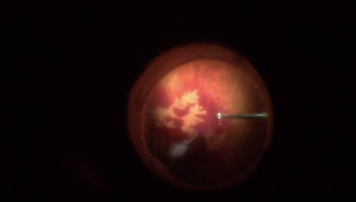 Severe PDR With Macular Folds