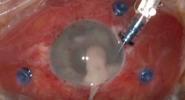Severe Endophthalmitis Due to Enterococcus Bacteria thumbnail