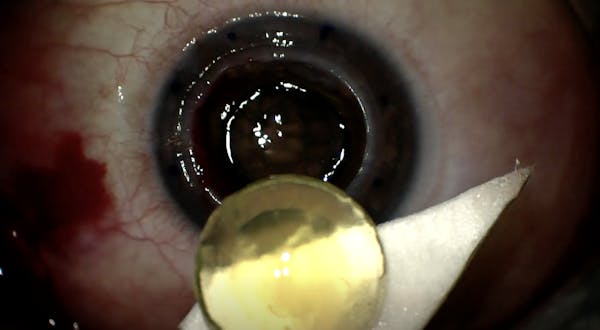 Penetrating Keratoplasty Extracapsular Cataract Extraction thumbnail