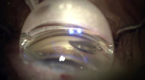 Efficiency of the Hydrus Microstent