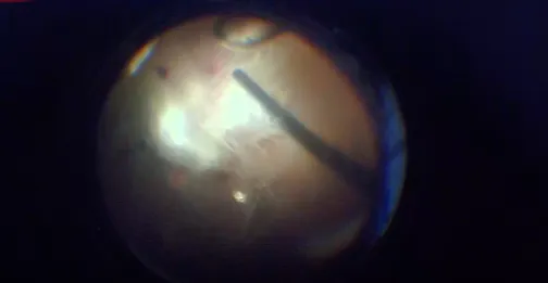 IOFB in the Eye of a Patient Who Sustained Injuries From an Explosive Device