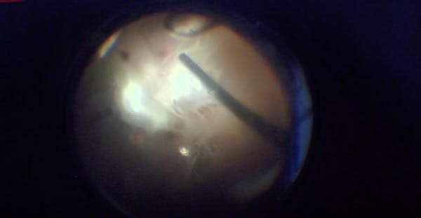 IOFB in the Eye of a Patient Who Sustained Injuries From an Explosive Device thumbnail