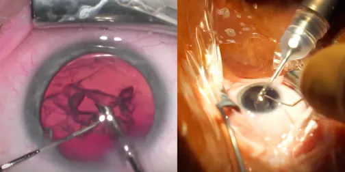 Viscoelastic Irrigation Pressurized Cataract Surgery
