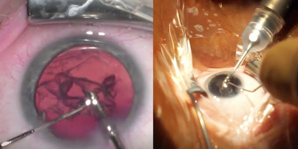 Viscoelastic Irrigation Pressurized Cataract Surgery thumbnail