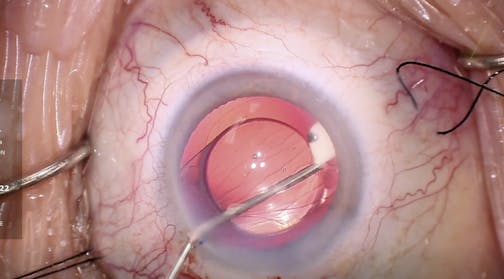 Dexycu Under the Anterior Capsule