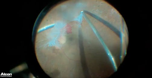 3D Tractional Retinal Detachment
