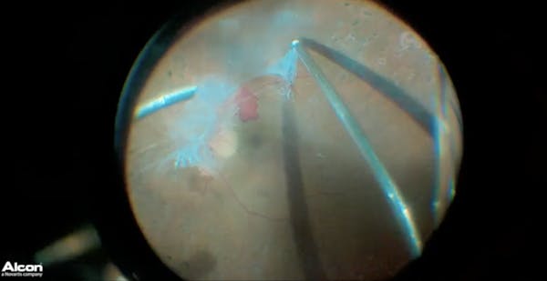 3D Tractional Retinal Detachment thumbnail